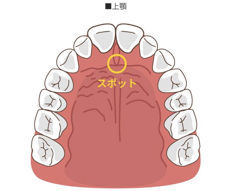 舌突出症の人はどうなるでしょうか?
