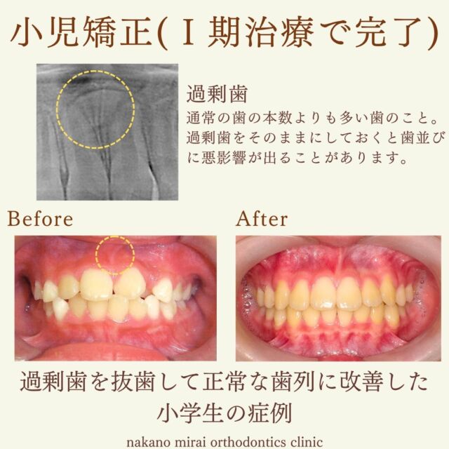 過剰歯を抜歯し、歯並びを改善した症例

小学生の患者様で、歯並びの改善を希望されていました。
診察させていただいたところ、前歯が部分的に反対咬合になっていて、軽度のガタガタになっていました。

レントゲンを撮影したところ、前歯の歯茎内部に過剰歯（本来生えてこない歯）が埋まっていることがわかりました。

過剰歯が原因で歯並びが悪くなっていた可能性が高かったため、抜歯した後に小児矯正を始めました。
過剰歯を抜歯するかしないかは矯正医でも判断が迷うところですので、よく相談されるとよいでしょう。

治療後は正常な歯並びに改善されました。
今後大きな顎位の変化や成長がない限り2期治療（大人の矯正）に移行することはなく、抜歯矯正の必要もありません。

【費用・期間】
総額¥480,000（＋税）
※過剰歯抜歯費用を除く
治療期間　保定期間を入れて約5年

【リスク・副作用について】
歯の動き方には個人差があります。
装置の装着後と調整後は、歯の移動により1～3日ほど痛みを伴うことがあります。
固定式の装置の場合、歯ブラシが届きにくく、虫歯や歯周病（歯肉炎）のリスクが伴います。
取り外し式の装置の場合、ご本人・保護者の方のご協力により治療結果に影響がでます。
歯が後戻りすることがあります。保定装置（リテーナー）装置を指示通りにご使用お願いします。
親知らずの影響や加齢変化などにより歯並びが乱れることがあります。

【無料相談のご予約・お問い合わせ】
☎︎ 03-6454-1040
📱 https://nakano-kyousei.com/counseling/form/

#矯正歯科 #歯科矯正 #矯正専門医 #目立たない矯正 #ワイヤー矯正 #矯正 #歯列矯正 #マウスピース矯正 #インビザライン #横顔 #口元 #過剰歯 #大人の矯正 #Eライン #歯科衛生士 #中野 #中野駅 #中野区 #無料相談 #可愛くなりたい #綺麗になりたい #ビフォーアフター #小児矯正 #子どもの矯正 #子供の矯正 #小児歯科 #小児歯科矯正