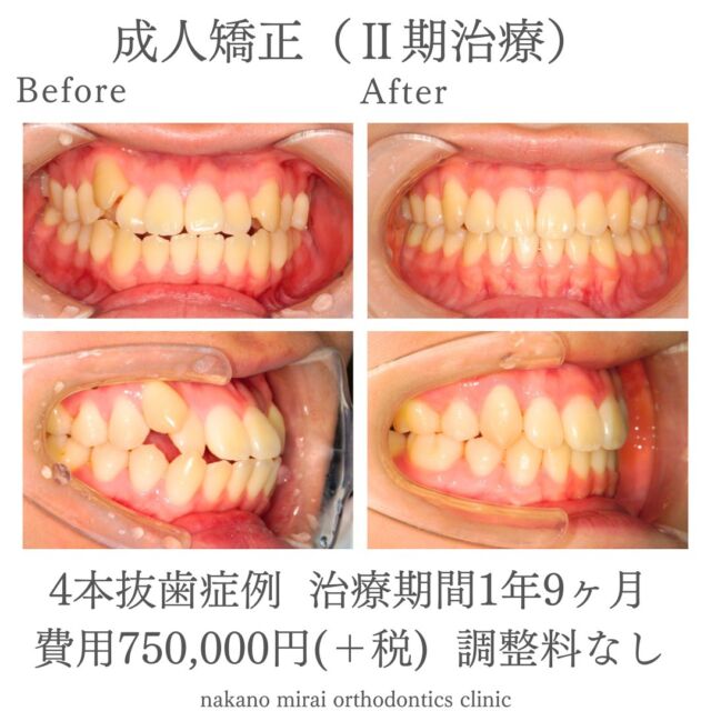 全顎矯正（ワイヤー矯正）を行って八重歯を改善した成人女性の症例写真

治療期間：１年９ヶ月
総額費用：¥750,000（＋税）
　　　　　 調整料なし

成人の患者様で、右上の八重歯の改善を希望されていました。
診察させていただいたところ、上下の前歯に叢生（ガタガタ）があり、右上の犬歯がいわゆる八重歯の状態でした。

2年以内に治療が終了し、治療後は八重歯とかみ合わせが改善されました。

リトラクション量が多いときは、前歯はもちろん大臼歯のトルクコントロールにも気をつけて治療することがポイントです。

【リスク・副作用】
固定式の装置は、歯磨き等のメンテナンスをしっかりしないと虫歯や歯周病の可能性が高くなります。
来院間隔があいてしまいますと、治療期間も伸びてしまいます。
歯を動かすことで、歯根吸収（歯の根が溶けて短くなる）や、ブラックトライアングル（歯と歯の間の三角形の隙間）や歯肉退縮が起こることがあります。

【無料相談のご予約・お問い合わせ】
☎︎ 03-6454-1040
📱 https://nakano-kyousei.com/counseling/form/

#矯正歯科 #歯科矯正 #矯正専門医 #目立たない矯正 #ワイヤー矯正 #矯正 #歯列矯正 #横顔美人 #横顔 #口元 #口元美人 #大人の矯正 #Eライン #歯科衛生士 #中野 #中野駅 #中野区 #無料相談 #部分矯正 #美容好きな人と繋がりたい #可愛くなりたい #綺麗になりたい #ビフォーアフター #健康 #治療 #医療 #症例写真 #歯科治療 #かみ合わせ