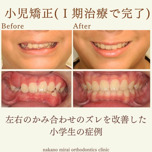 左右のかみ合わせのバランスを改善し、1期治療で完了した小学生の症例写真

小学生の患者様で、かみ合わせの改善を希望されていました。
診察させていただいたところ、過蓋咬合（深いかみ合わせ）と咬合平面の乱れがあり、さらに左下の犬歯が前方に生えてきている状態かつ下顎前歯に叢生がありました。

２期治療（大人の矯正）になるべく移行しないよう治療計画を立て、治療を進めていきました。

治療後には叢生、かみ合わせが改善され、咬合平面の乱れがなくなり自然なスマイルラインになりました。

今後大きな顎位の変化や成長がない限り、2期治療（大人の矯正）に移行することはありません。

2次的な効果で、治療前後で姿勢の改善も認められました。

【費用・期間】
総額¥500,000（＋税）
治療期間　保定期間を入れて約4年

【リスク・副作用について】
歯の動き方には個人差があります。
装置の装着後と調整後は、歯の移動により1～3日ほど痛みを伴うことがあります。
固定式の装置の場合、歯ブラシが届きにくく、虫歯や歯周病（歯肉炎）のリスクが伴います。
取り外し式の装置の場合、ご本人・保護者の方のご協力により治療結果に影響がでます。
歯が後戻りすることがあります。保定装置（リテーナー）装置を指示通りにご使用お願いします。
親知らずの影響や加齢変化などにより歯並びが乱れることがあります。

【無料相談のご予約・お問い合わせ】
☎︎ 03-6454-1040
📱 https://nakano-kyousei.com/counseling/form/

#矯正歯科 #歯科矯正 #矯正専門医 #目立たない矯正 #ワイヤー矯正 #矯正 #歯列矯正 #マウスピース矯正 #横顔 #大人の矯正 #口元 #歯科衛生士 #マルチブラケット #中野駅 #中野区 #無料相談 #可愛くなりたい #綺麗になりたい #ビフォーアフター #小児矯正 #子どもの矯正 #子供の矯正 #小児歯科 #小児歯科矯正 #姿勢 #健康 #かみ合わせ