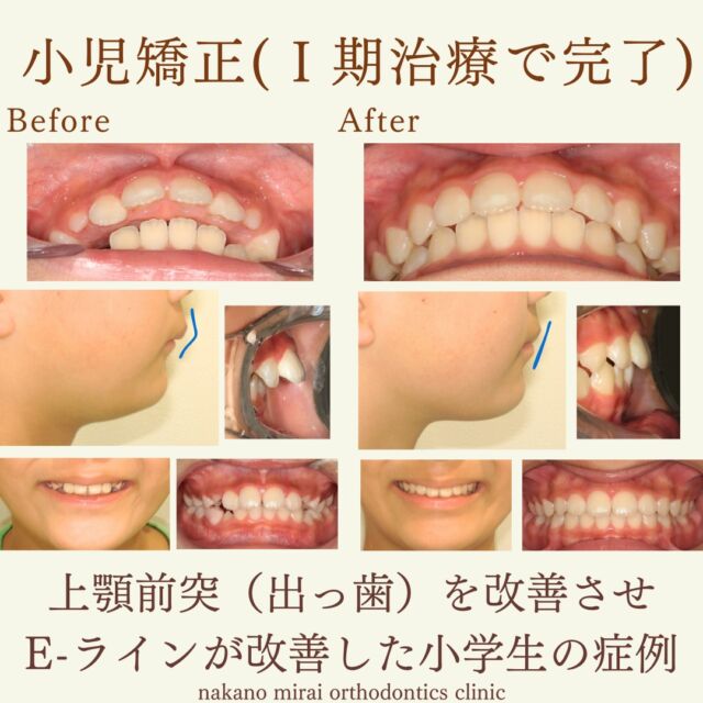 上顎前突を改善させ、正常咬合を達成した小学生の症例写真
小学生の患者様で出っ歯の改善を希望されていました。
診察させていただいたところ、口を閉じると上唇に膨らみがあって口が閉じづらく骨格的に上顎が前方に位置していました。
また、上顎の前歯は軽度のガタガタとすきっ歯でオーバージェット(上下の前歯の隙間の距離)は10.0㎜と平均よりも7~8㎜も大きい状態でした。
正常咬合を目指し、2期治療が必要ならなくなるよう治療方針を立てました。
MFT(お口のトレーニング)を中心とした歯に負担の少ない治療計画を立てました。
本症例のポイントはワイヤー矯正を極力避け、1期治療で治療を完了させることを目標に治療方針を立てたことです。1期治療での上顎前突の改善は治療としては難しい部類ですが、本人と保護者様に治療のゴールと方針をご納得いただき治療に取り組むことが大切です。
治療後は上顎前突が改善し、理想的なかみ合わせである正常咬合になりました。さらに横顔の見た目のイーラインが整い、審美的にも納得感ある仕上がりになりました。
今後大きな顎位の変化や成長がない限り、2期治療(大人の矯正)に移行することはなく抜歯矯正の必要もありません。
【費用・期間】
総額¥480,000(+税)
治療期間 保定期間を入れて約4年
【リスク・副作用について】
歯の動き方には個人差があります。
装置の装着後と調整後は、歯の移動により1~3日ほど痛みを伴うことがあります。
固定式の装置の場合、歯ブラシが届きにくく、虫歯や歯周病(歯肉炎)のリスクが伴います。
取り外し式の装置の場合、ご本人・保護者の方のご協力により治療結果に影響がでます。
歯が後戻りすることがあります。保定装置(リテーナー)装置を指示通りにご使用お願いします。
親知らずの影響や加齢変化などにより歯並びが乱れることがあります。
【無料相談のご予約・お問い合わせ】
☎︎ 03-6454-1040
📱 https://nakano-kyousei.com/counseling/form/
#矯正歯科 #歯科矯正 #矯正専門医 #目立たない矯正 #ワイヤー矯正 #矯正 #歯列矯正 #マウスピース矯正 #インビザライン #横顔 #口元 #口元美人 #大人の矯正 #Eライン #歯科衛生士 #中野 #中野駅 #中野区 #無料相談 #可愛くなりたい #綺麗になりたい #ビフォーアフター #出っ歯 #出っ歯矯正 #小児矯正 #子どもの矯正 #イーライン
