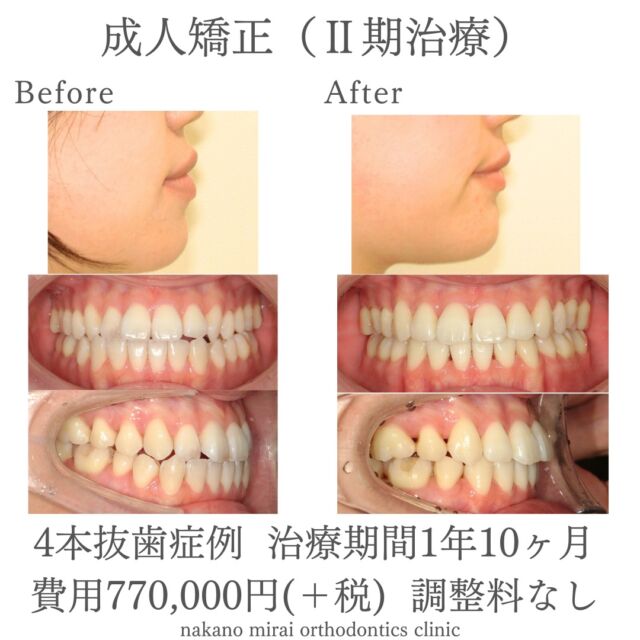 上下顎小臼歯を計4本抜歯してEラインが改善された症例写真
【費用・期間】
総額¥770,000(+税)
1年10ヶ月
上下4本の小臼歯を抜歯して、上下の前歯を後ろに引っ込めたことによって口元のEラインを改善しました。
Eラインを整えると、審美的な改善や口元が閉じやすくなるといったメリットがあります。
【リスク・副作用】
固定式の装置は、歯磨き等のメンテナンスをしっかりしないと虫歯や歯周病の可能性が高くなります。
来院間隔があいてしまいますと、治療期間も伸びてしまいます。
歯を動かすことで、歯根吸収(歯の根が溶けて短くなる)や、ブラックトライアングル(歯と歯の間の三角形の隙間)や歯肉退縮が起こることがあります。
【無料相談のご予約・お問い合わせ】
☎︎ 03-6454-1040
📱 https://nakano-kyousei.com/counseling/form/
#矯正歯科 #歯科矯正 #矯正専門医 #目立たない矯正 #ワイヤー矯正 #矯正 #歯列矯正 #マウスピース矯正 #インビザライン #横顔美人 #横顔 #口元 #口元美人 #大人の矯正 #Eライン #歯科衛生士 #中野 #中野駅 #中野区 #無料相談 #部分矯正 #美容好きな人と繋がりたい #可愛くなりたい #綺麗になりたい #ビフォーアフター