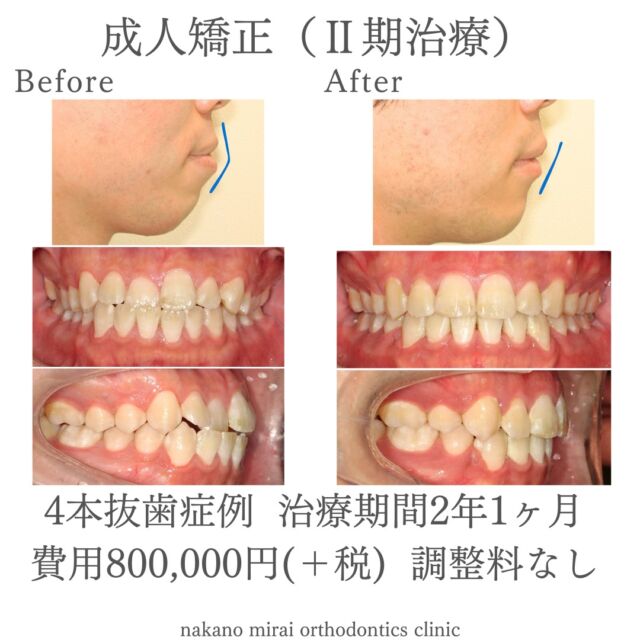 全顎矯正（ワイヤー矯正）を行ってEラインを改善した成人男性の症例写真

治療期間：2年1ヶ月
総額費用：¥800,000（＋税）
　　　　　 調整料なし

成人の患者様で、口元の改善と前歯のかみ合わせの改善を希望されていました。
診察させていただいたところ、右上の前歯が後ろにあり、口ゴボの状態でした。

治療後は前歯のかみ合わせと口ゴボが改善され、アンチローテーションを達成しEラインが整いました。

本症例は非抜歯も適応になりますが、口ゴボを改善してEラインを良くしたい場合には抜歯が必要になります。
スライディングメカニクスを用いたことでゴムかけの負担を減らし、比較的短期間で終えることができました。

【リスク・副作用】
固定式の装置は、歯磨き等のメンテナンスをしっかりしないと虫歯や歯周病の可能性が高くなります。
来院間隔があいてしまいますと、治療期間も伸びてしまいます。
歯を動かすことで、歯根吸収（歯の根が溶けて短くなる）や、ブラックトライアングル（歯と歯の間の三角形の隙間）や歯肉退縮が起こることがあります。

【無料相談のご予約・お問い合わせ】
☎︎ 03-6454-1040
📱 https://nakano-kyousei.com/counseling/form/

#矯正歯科 #歯科矯正 #矯正専門医 #目立たない矯正 #ワイヤー矯正 #矯正 #歯列矯正 #横顔美人 #横顔 #口元 #口元美人 #大人の矯正 #Eライン #歯科衛生士 #中野 #中野駅 #中野区 #無料相談 #部分矯正 #美容好きな人と繋がりたい #可愛くなりたい #綺麗になりたい #ビフォーアフター #健康 #治療 #医療 #症例写真 #歯科治療 #かみ合わせ