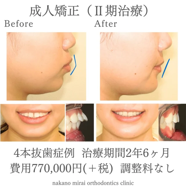全顎矯正（ワイヤー矯正）を行ってEラインを改善した成人女性の症例写真

治療期間：2年6ヶ月
総額費用：¥770,000（＋税）＋装置再装着代
　　　　　 調整料なし

成人の患者様で、口元の改善いわゆる口ゴボの改善を希望されていました。
診察させていただいたところ、前歯はすきっ歯と出っ歯の状態であり、口が閉じづらい口ゴボの状態でした。

治療後は口ゴボが改善され、Eラインが整いました。

本症例は一時的に装置を除去し、再度装着する手順を踏んだため、治療期間が2年6ヶ月となりましたが、動的処置を行っている期間は2年3ヶ月ほどでした。
一時的に装置を除去する方は、抜歯したスペースに仮歯を装着いたします。

【リスク・副作用】
固定式の装置は、歯磨き等のメンテナンスをしっかりしないと虫歯や歯周病の可能性が高くなります。
来院間隔があいてしまいますと、治療期間も伸びてしまいます。
歯を動かすことで、歯根吸収（歯の根が溶けて短くなる）や、ブラックトライアングル（歯と歯の間の三角形の隙間）や歯肉退縮が起こることがあります。

【無料相談のご予約・お問い合わせ】
☎︎ 03-6454-1040
📱 https://nakano-kyousei.com/counseling/form/

#矯正歯科 #歯科矯正 #矯正専門医 #目立たない矯正 #ワイヤー矯正 #矯正 #歯列矯正 #横顔美人 #横顔 #口元 #口元美人 #大人の矯正 #Eライン #美容 #中野 #口ゴボ #すきっ歯 #無料相談 #部分矯正 #美容好きな人と繋がりたい #可愛くなりたい #綺麗になりたい #ビフォーアフター #健康 #治療 #医療 #症例写真 #歯科治療 #かみ合わせ #出っ歯