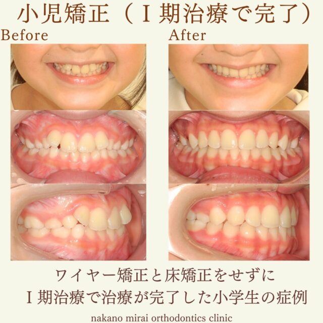 ワイヤー矯正と床矯正をしないことで矯正後の後戻りのリスクを極力減らし、1期治療で完了した小学生の症例写真

小学生の患者様で、「前歯の歯並びが気になる」ことを主訴に来院されました。
診察させていただいたところ、上の前歯がナナメに生えている状態であり、歯が真っすぐに生えるスペースが足りない状態でした。

当院では２期治療（大人の矯正）になるべく移行しないよう治療計画を立てます。

ワイヤー矯正と顎を拡げる拡大床を使用するとリバウンド（後戻り）が強く出てしまうため、両方とも使用せずに治療をしました。また、1日中装着しないといけないタイプのマウスピース矯正は本人の負担が大きくなるため使用していません。

治療後には歯並びとかみ合わせが改善されました。

ワイヤー矯正をしなかったことでリバウンド（後戻り）のリスクを極力減らすことができ、治療中の患者さんの負担も大きく低減できました。

今後大きな顎位の変化や成長がない限り、2期治療（大人の矯正）に移行することはありません。

本症例はパッと見た感じは簡単な症例に見えますが、後戻りのことをケアしてワイヤーを使用しない治療となるとかなり難しくなるケースです。
慎重に治療を進めていくことと、本人とご家族の協力が重要となります。

【費用・期間】
総額¥500,000（＋税）
治療期間　保定期間を入れて約5年

【リスク・副作用について】
歯の動き方には個人差があります。
装置の装着後と調整後は、歯の移動により1～3日ほど痛みを伴うことがあります。
固定式の装置の場合、歯ブラシが届きにくく、虫歯や歯周病（歯肉炎）のリスクが伴います。
取り外し式の装置の場合、ご本人・保護者の方のご協力により治療結果に影響がでます。
歯が後戻りすることがあります。保定装置（リテーナー）装置を指示通りにご使用お願いします。
親知らずの影響や加齢変化などにより歯並びが乱れることがあります。

【無料相談のご予約・お問い合わせ】
☎︎ 03-6454-1040
📱 https://nakano-kyousei.com/counseling/form/

#矯正歯科 #歯科矯正 #矯正専門医 #目立たない矯正 #ワイヤー矯正 #矯正 #歯列矯正 #マウスピース矯正 #横顔 #床矯正 #拡大床 #大人の矯正 #口元 #歯科衛生士 #マルチブラケット #中野駅 #中野区 #無料相談 #可愛くなりたい #綺麗になりたい #ビフォーアフター #小児矯正 #子どもの矯正 #子供の矯正 #小児歯科 #小児歯科矯正